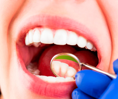 denttures vs bridges