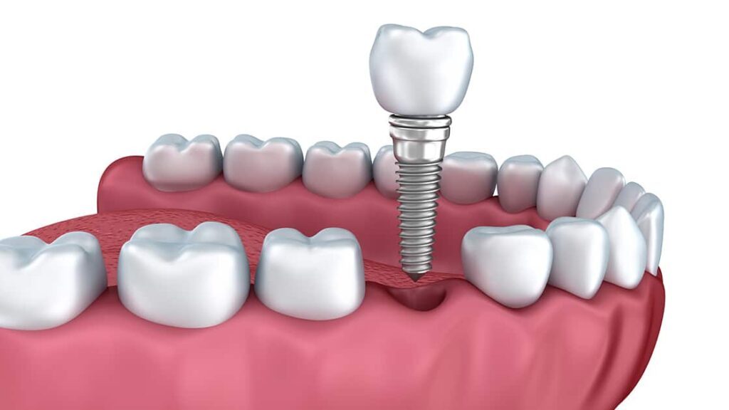 Costs For Dental Implants Washington District Of Columbia