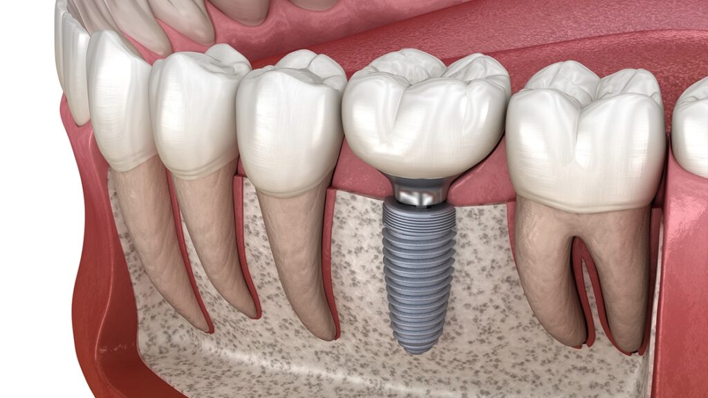 Costs For Dental Implants Washington District Of Columbia