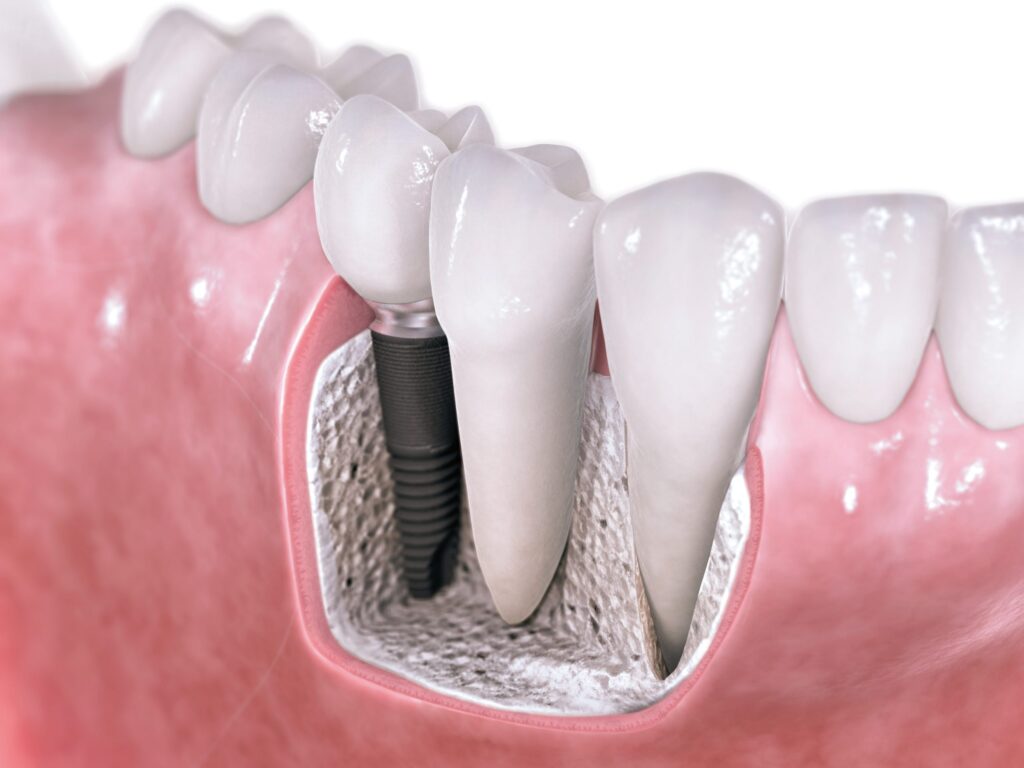 Costs For Dental Implants Washington District Of Columbia