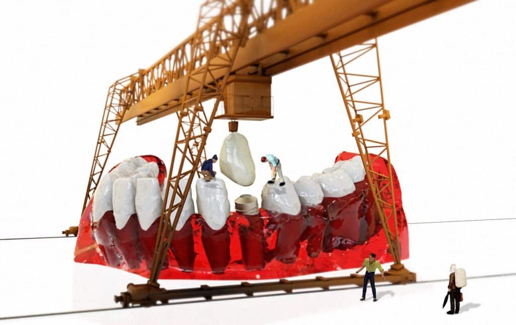 Costs For Dental Implants Amarillo Texas