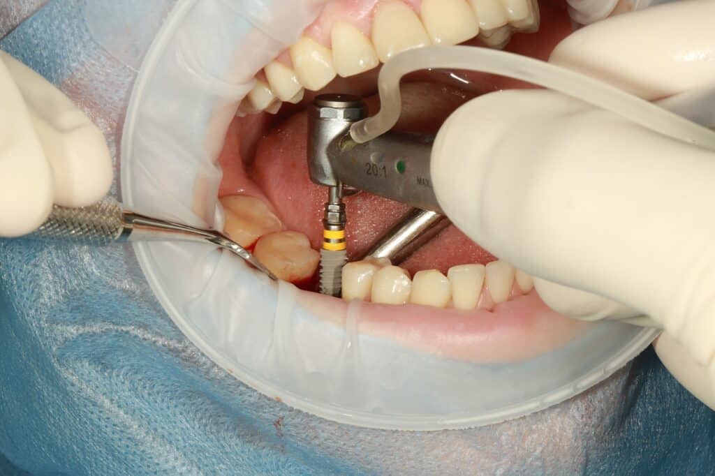 Costs For Dental Implants Eugene Oregon Costs For Dental Implants Eugene Oregon