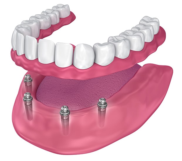 Costs For Dental Implants Altamonte Springs Florida