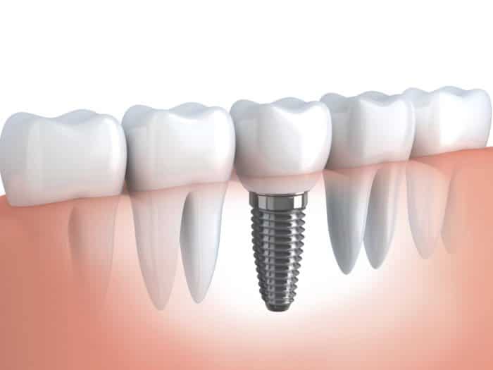 Costs For Dental Implants Altamonte Springs Florida