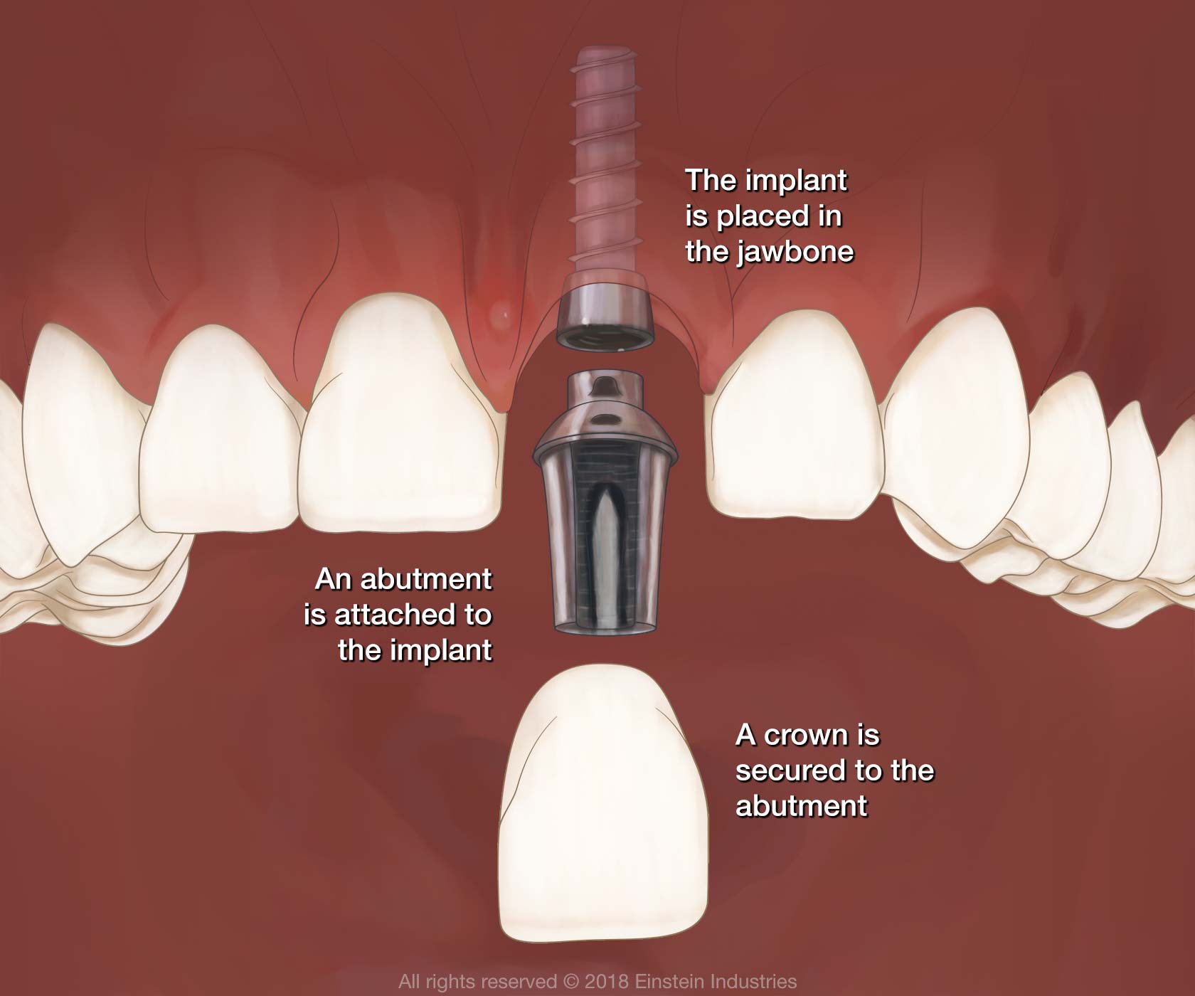 Costs For Dental Implants Altamonte Springs Florida
