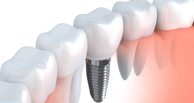 Costs For Dental Implants Altamonte Springs Florida