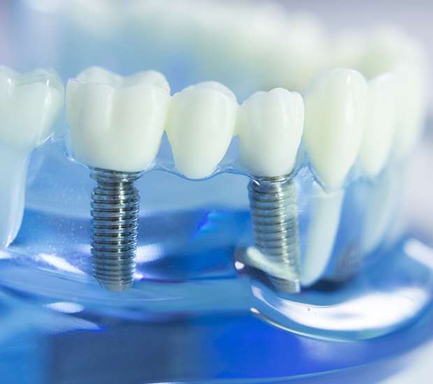 Costs For Dental Implants Altamonte Springs Florida