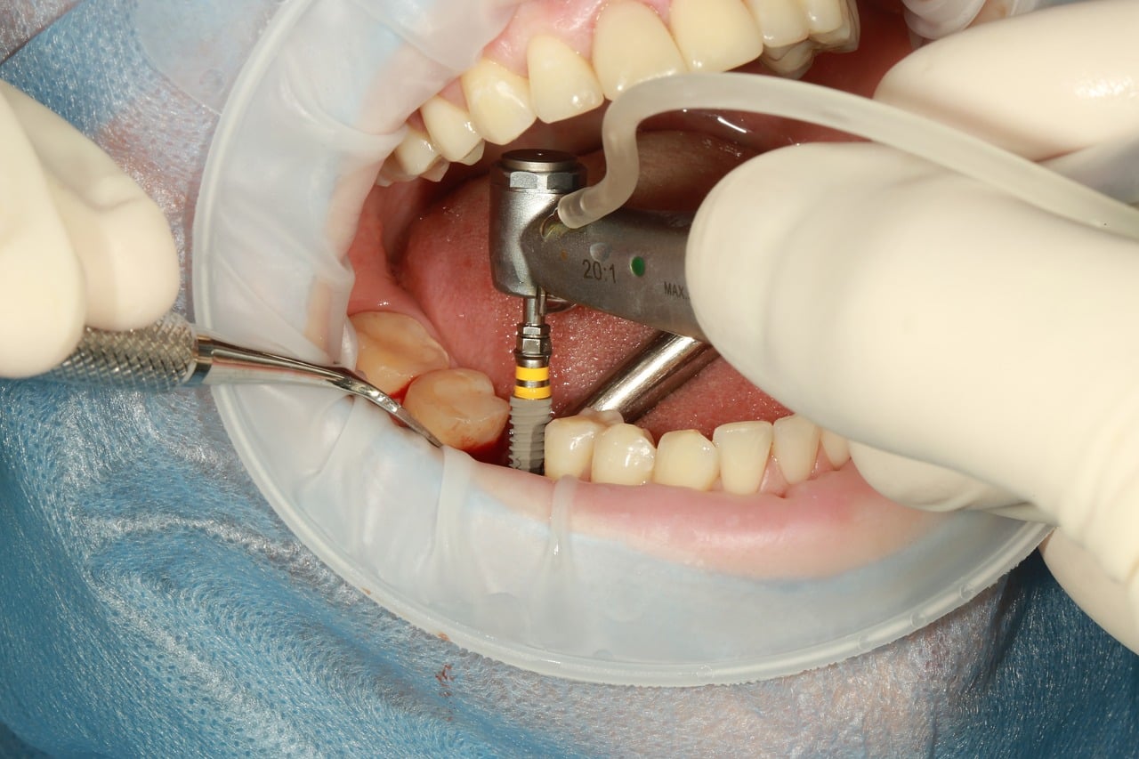 Costs For Dental Implants Burleson Texas