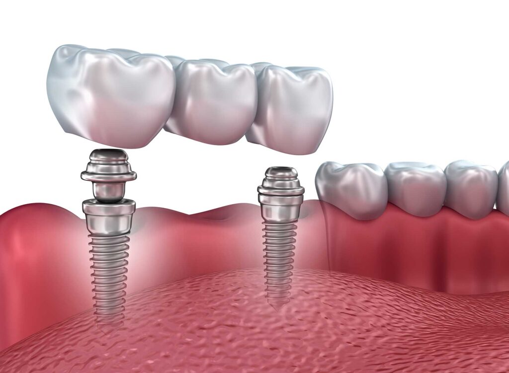 Costs For Dental Implants Florence South Carolina