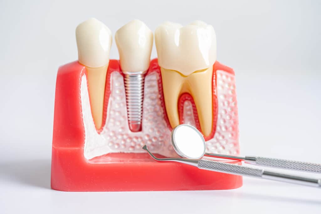 Costs For Dental Implants In Frisco Square Frisco Texas