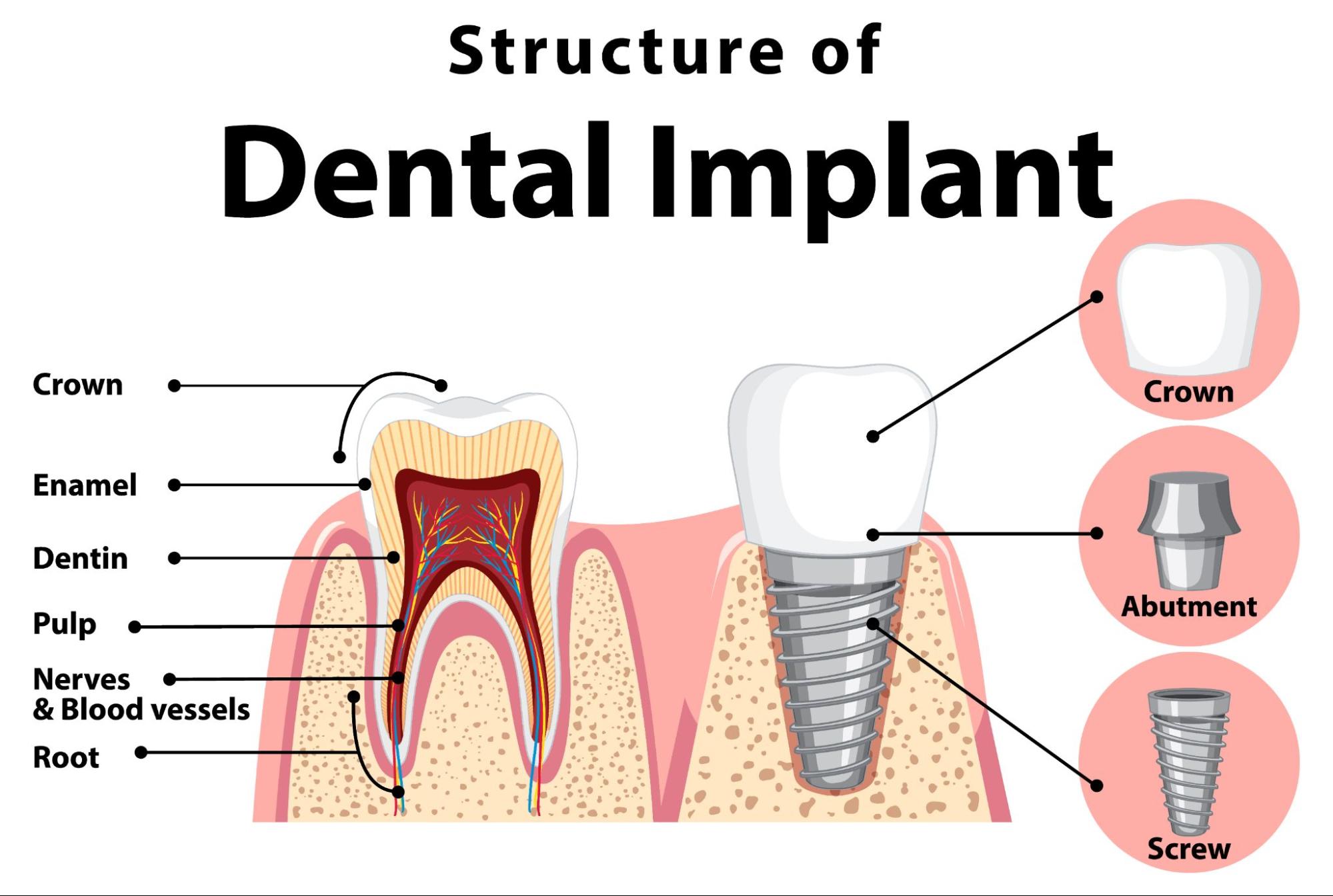Dental Implants: The Path To A More Fulfilling Life
