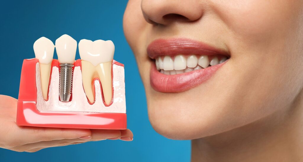 Costs For Dental Implants In Frisco Square Frisco Texas