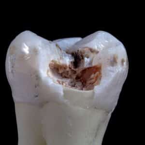 Photo Tooth implant