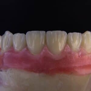 Photo Implant Surgery