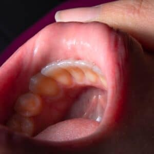 Photo Dental implant