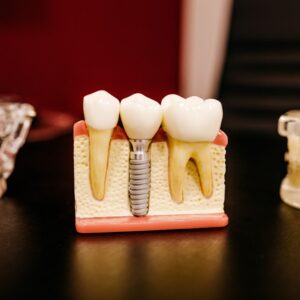 Photo Tooth implant