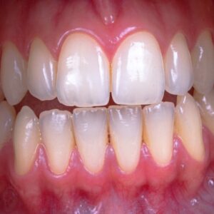 Photo Dental implant