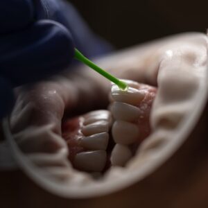 Photo Tooth implant