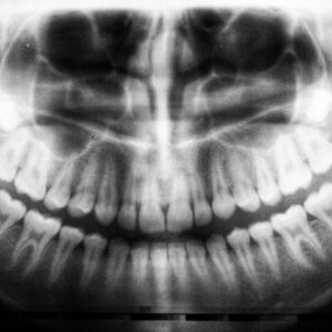 Photo Dental implant cost