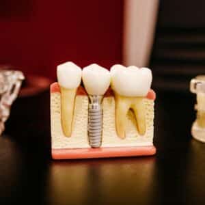 Photo Best Dental Implants North Miami Beach Florida