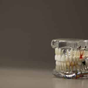 Photo "Best Dental Implants Crystal Lake Illinois"