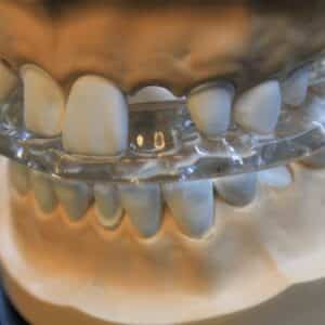 Photo Best Dental Implants North Lauderdale Florida
