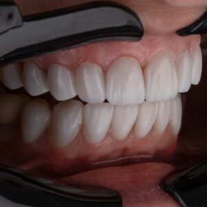 Photo Tooth implant