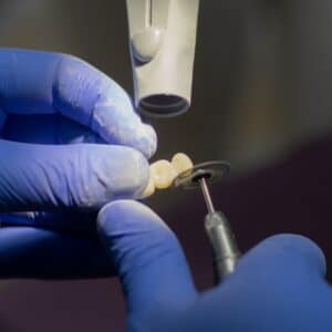 Photo Tooth implant
