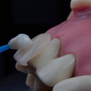 Photo Titanium Implant
