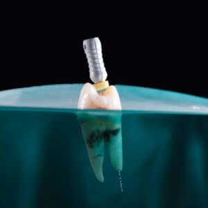 Photo Implant surgery