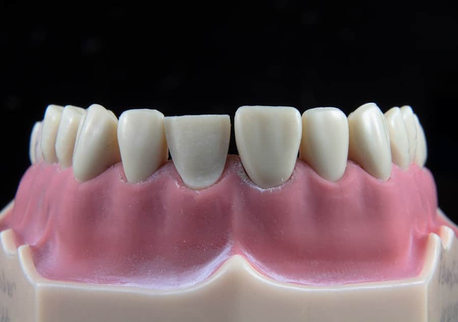 Dental Implant Surgery
