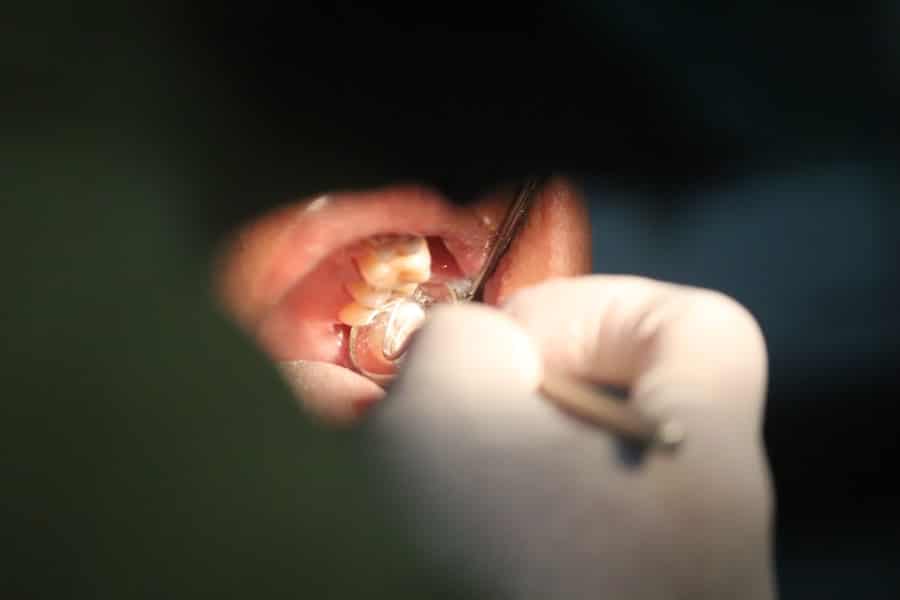 Implant Supported Dentures
