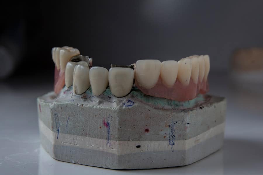 Teeth Replacement