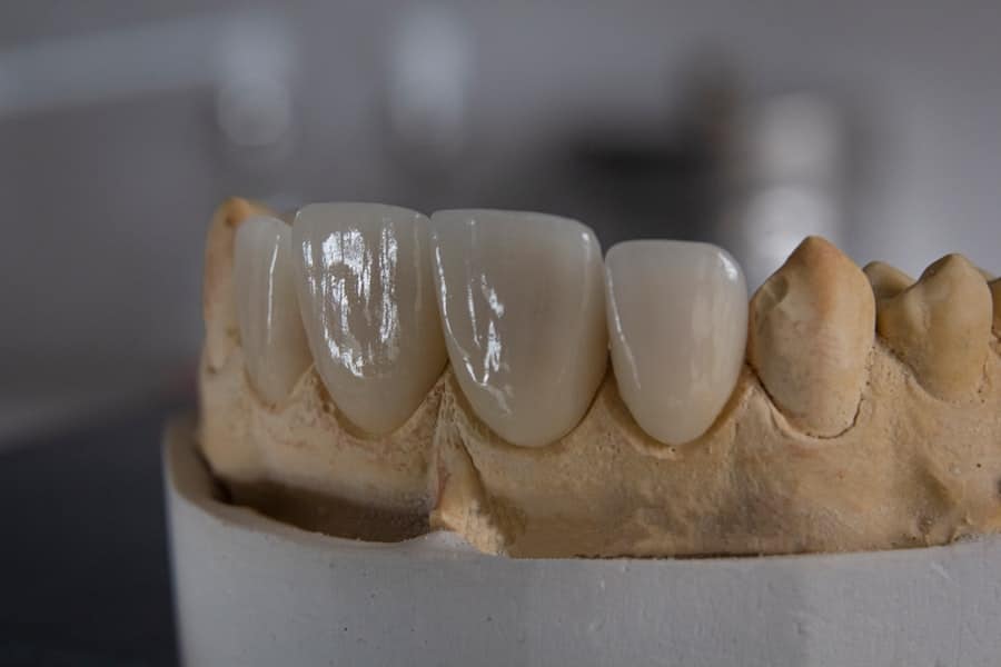 Dental Implant