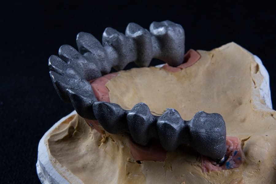 Dental Implants Last