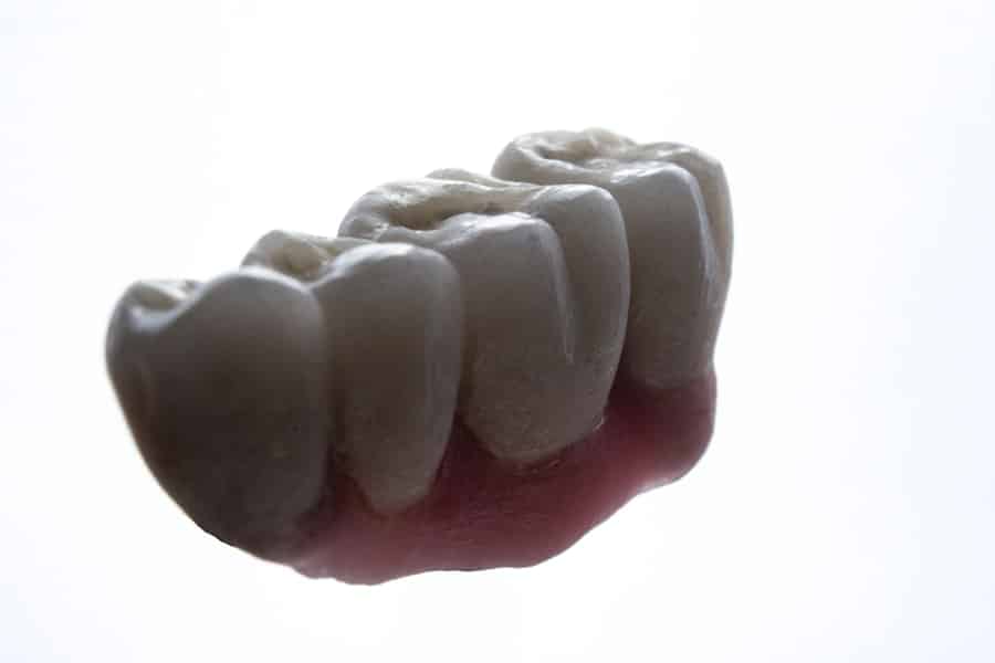Implant Retained Dentures