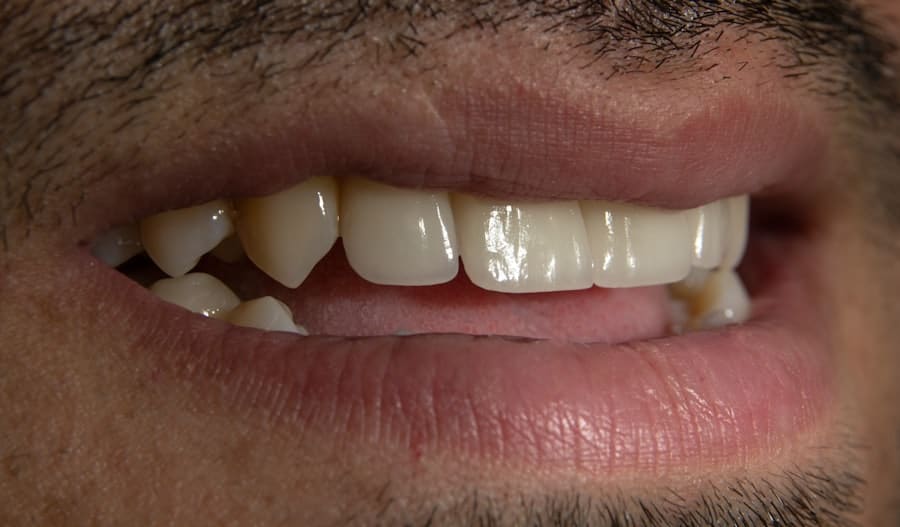 Full Mouth Rehabilitation