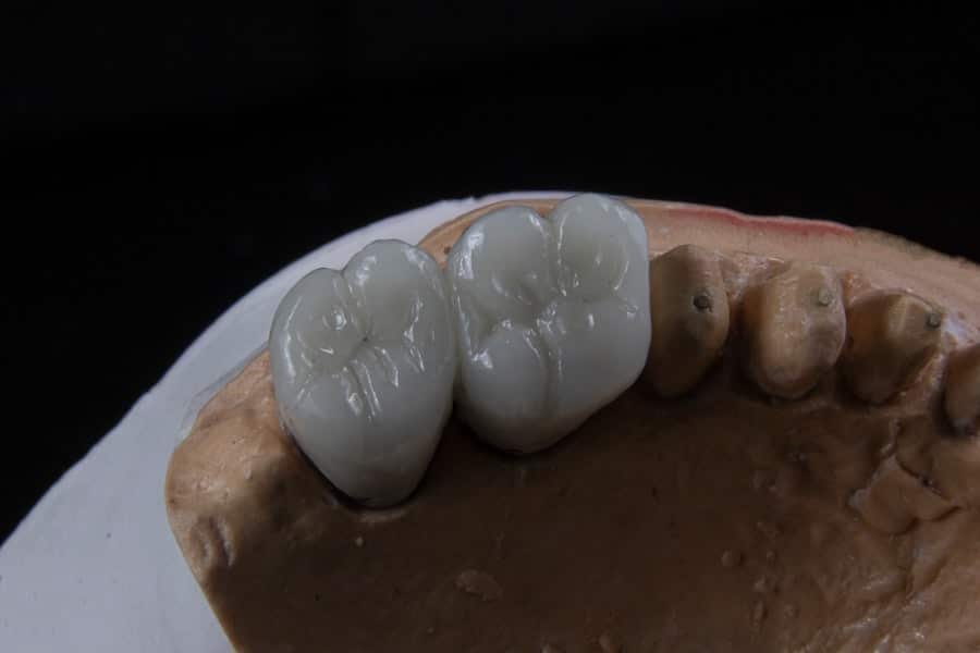 Photo Dental Implants