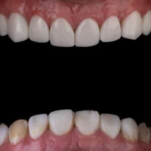 Photo Full Mouth Rehabilitation