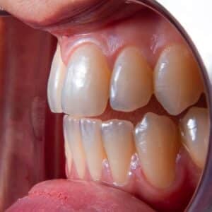 Photo Dental Implant Free Consultation