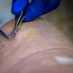 Photo Implant Package