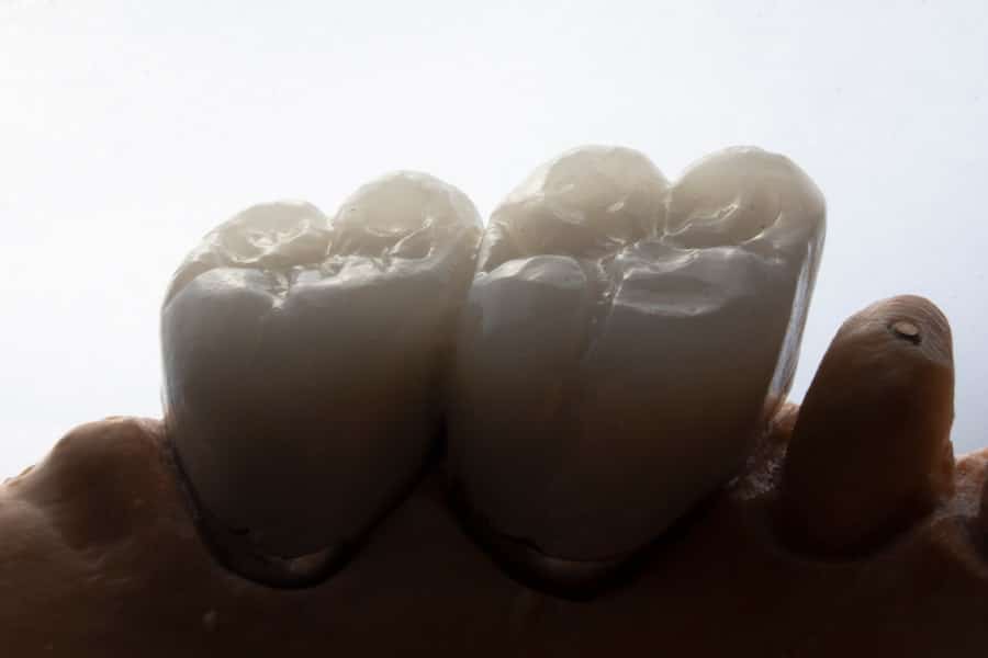 Photo Dental Implant Cost