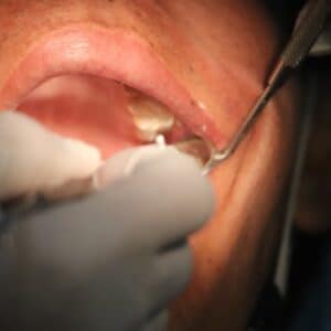 Photo Dental Implant Cost
