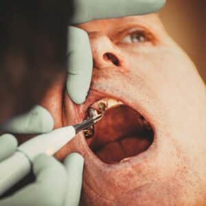 Photo Tooth Replacement