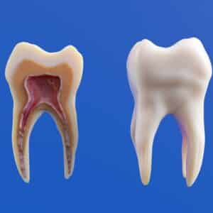 Photo Dental Implants Vs Dentures