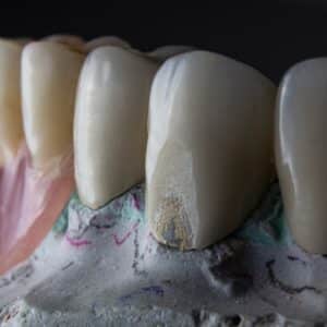 Photo Dental Implant Cost Comparison