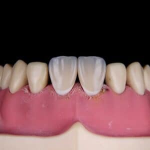Photo Dental Implant Alternatives