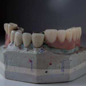 Photo Dental Implant Aftercare