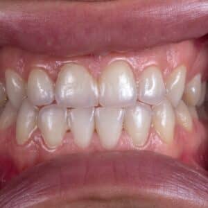 Photo Teeth Replacement