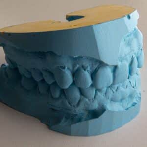 Photo Implant Supported Dentures